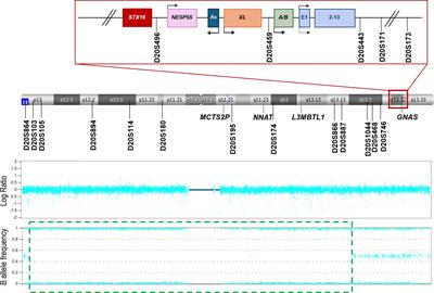 Heterodisomy in the GNAS locus is also a cause of pseudohypoparathyroidism type 1B (iPPSD3)